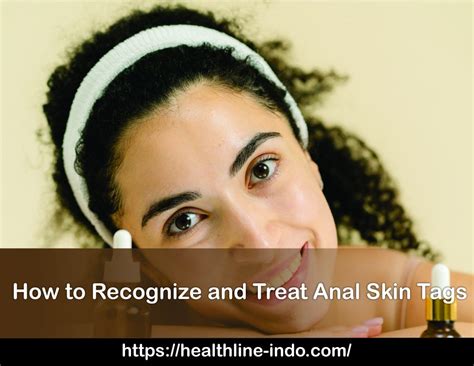 anale skin tags|How to Identify and Treat an Anal Skin Tag .